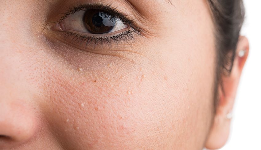 What Are Milia & How Do You Get Rid Of Them?